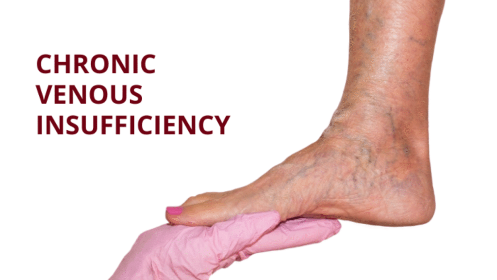 Chronic Venous Insufficiency ICD‑10