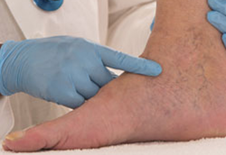 Chronic Venous Insufficiency ICD‑10