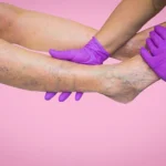 Chronic Venous Insufficiency ICD‑10