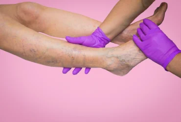 Chronic Venous Insufficiency ICD‑10